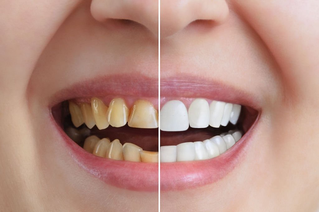 Cosmetic Dentistry Treatment